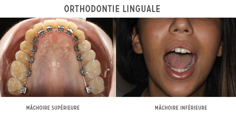 -appareils orthodontiques linguaux